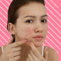 The Benefits of Using Topical Steroids for Cystic Acne Treatment