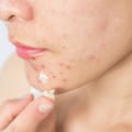 Sulfur-based Products for Cystic Acne