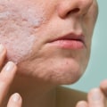 Understanding Benzoyl Peroxide for Cystic Acne