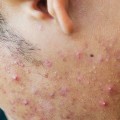 Genetic Predisposition to Cystic Acne