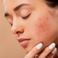 Relaxation Techniques for Stress Relief with Cyctic Acne