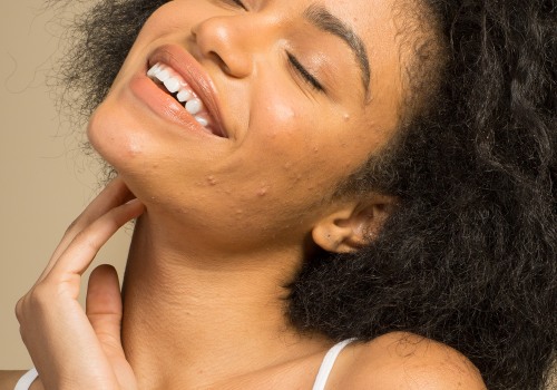 Exploring Oil-Free Moisturizers for Cystic Acne