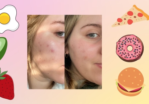 Foods to Eat with Cystic Acne