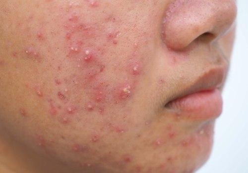 Understanding Familial History and Cystic Acne