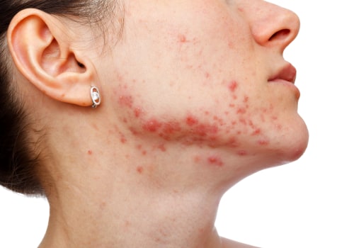 The Effects of Stress on Cystic Acne