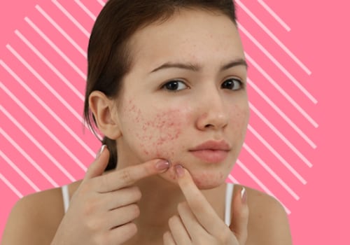 The Benefits of Using Topical Steroids for Cystic Acne Treatment