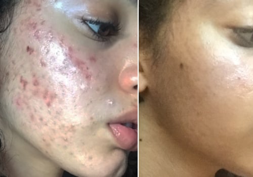 Exploring the Connection Between Cosmetics, Skin Care Products and Cystic Acne