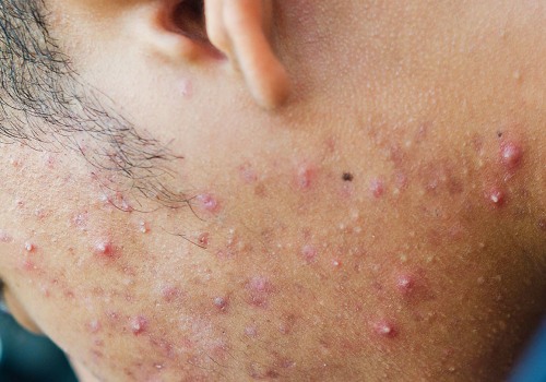 Genetic Predisposition to Cystic Acne