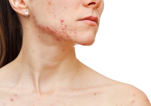 Sleep Hygiene to Reduce Cystic Acne Flares