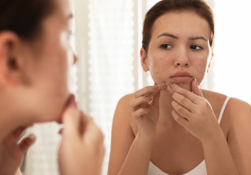 Understanding Gut Health and Its Impact on Cystic Acne