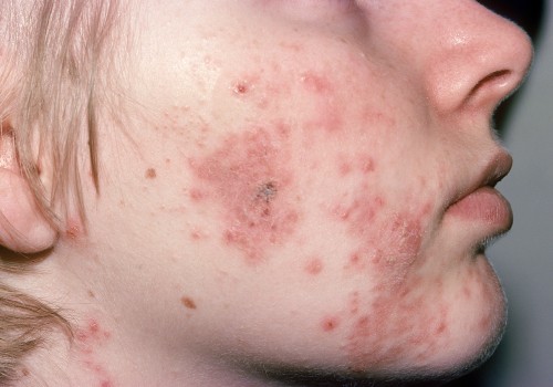 Understanding Immune System Disorders and Cystic Acne